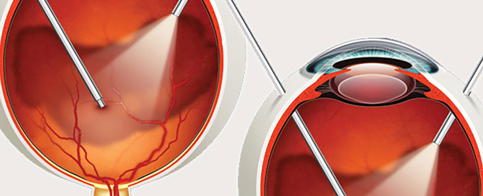 vitrectomy-surgery-post-operative-care